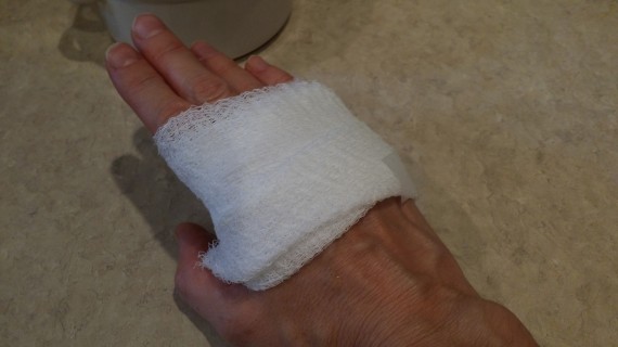 I burned my hand. Thankfully I had aloe to put on right away.